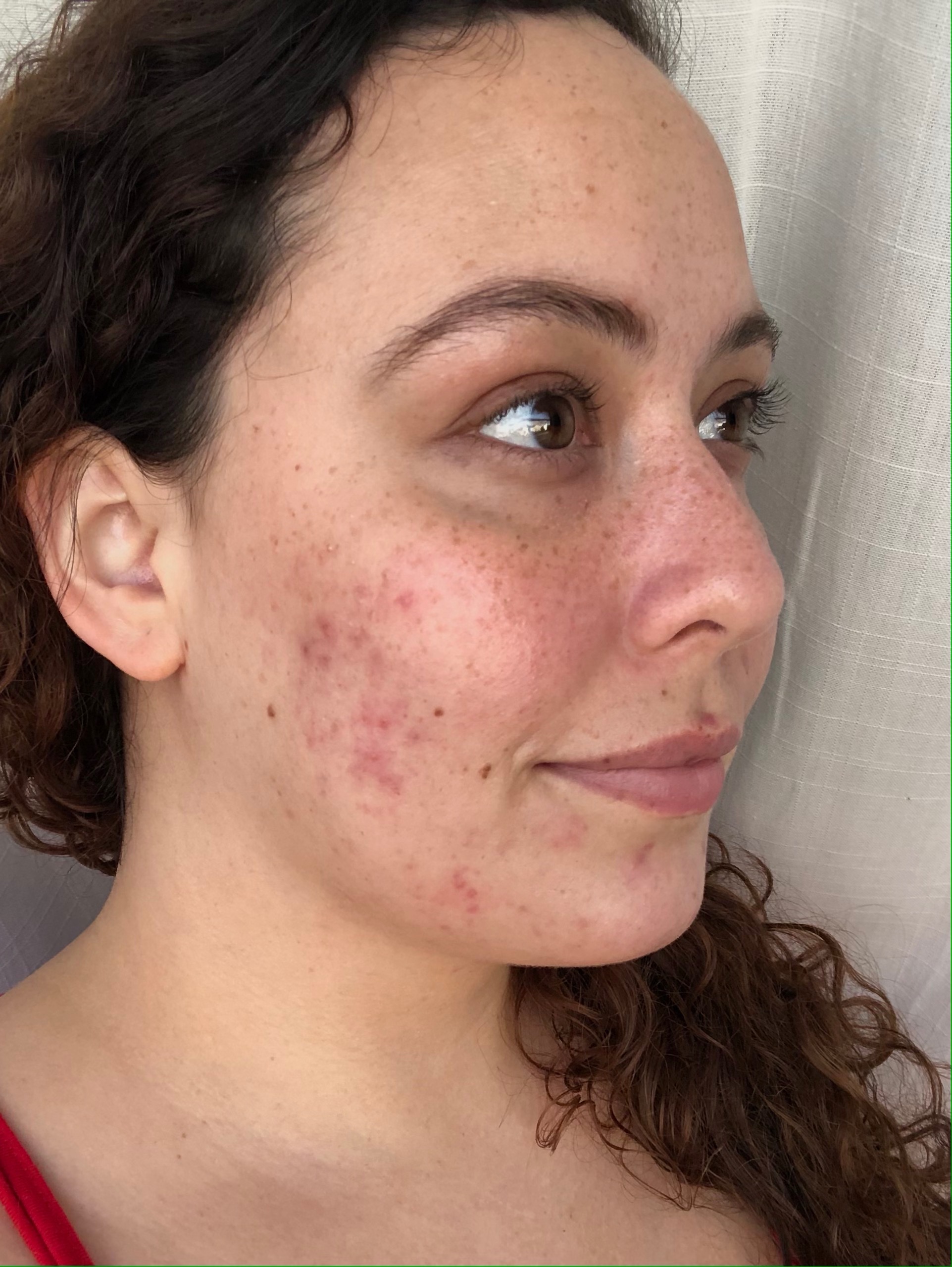 tretinoin journey